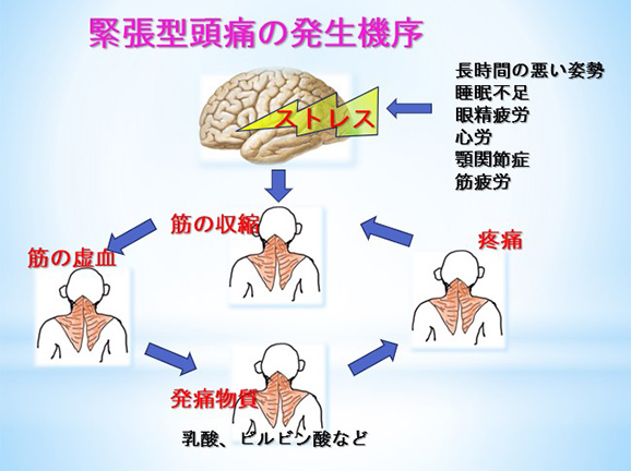 図2 緊張型頭痛の発生機序の模式図