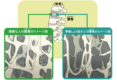 骨粗しょう症