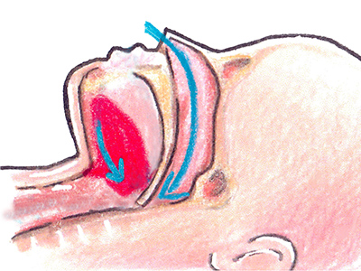 閉塞型睡眠時無呼吸症候群のイメージイラスト