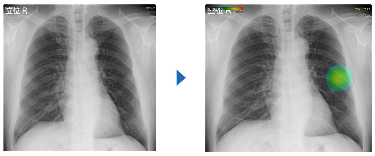 図: 左上葉肺がんの一例