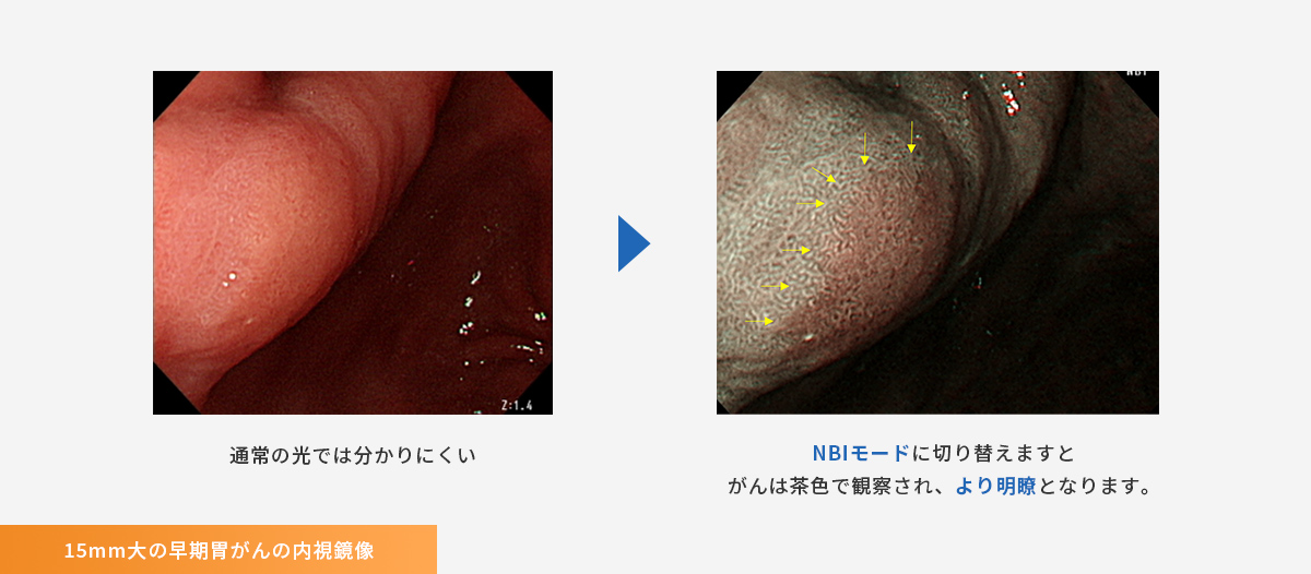 15mm大の早期胃がんの内視鏡像