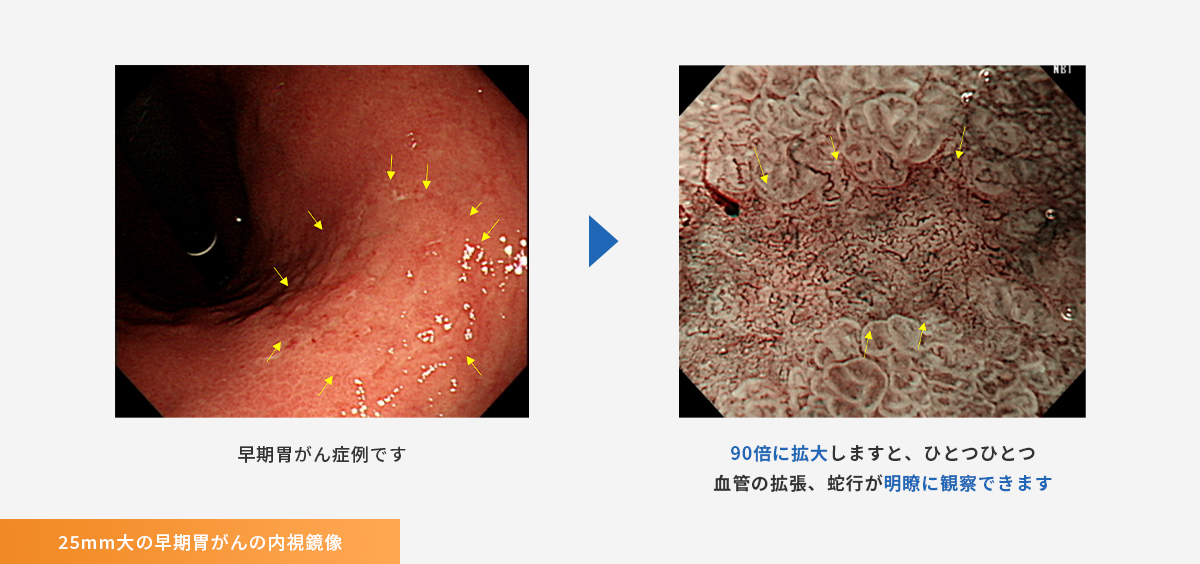 25mm大の早期胃がんの内視鏡像