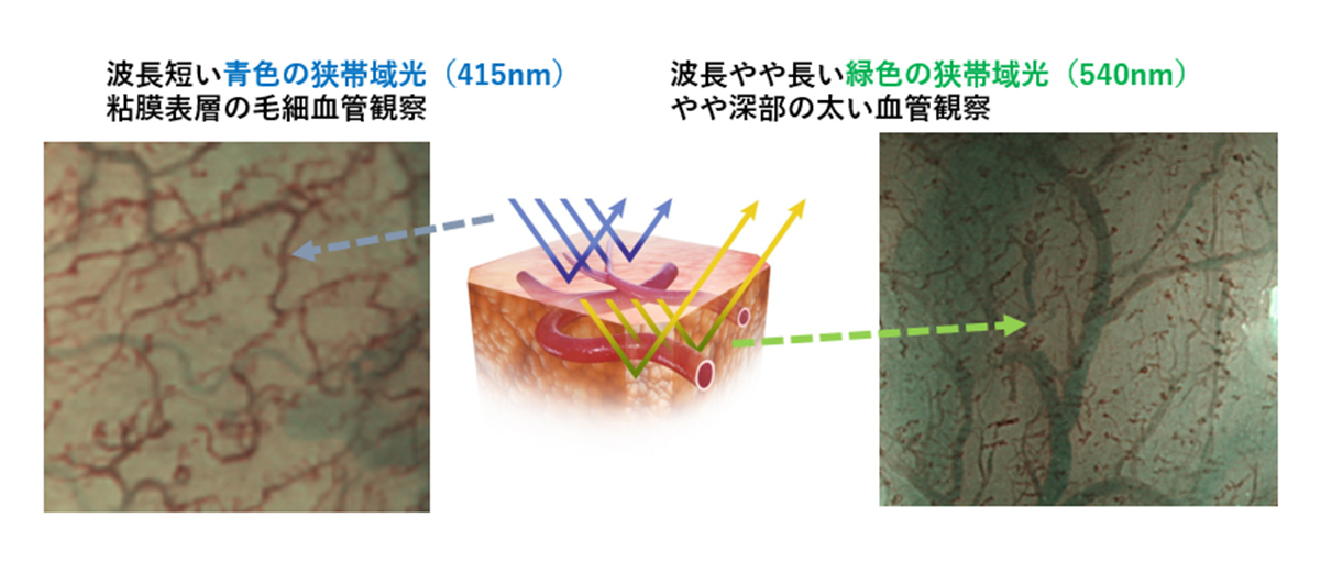Narrow Band Imaging:NBI(狭帯域光)
