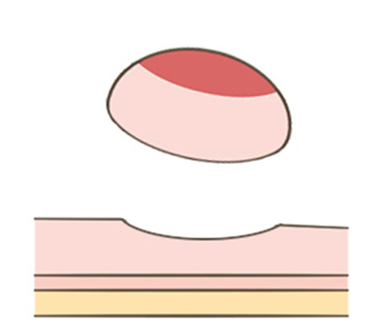 内視鏡的粘膜切除術