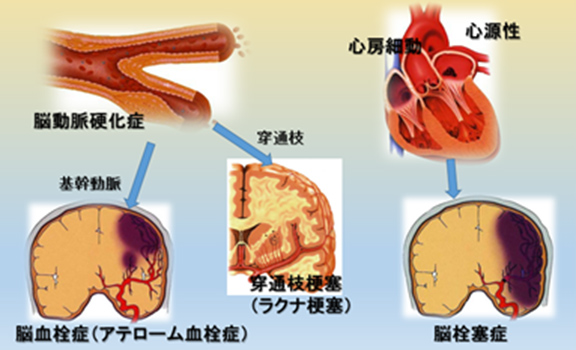 図1 脳梗塞の種類