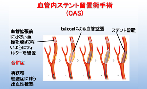 図3 血管内ステント術