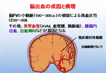 図4 脳出血の成因