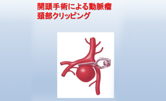 図5 開頭術による脳動脈瘤頚部クリッピング