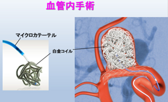 図6 血管内手術によるコイル栓塞術