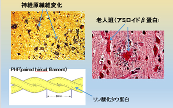 図5 アルツハイマー型認知症の脳病理