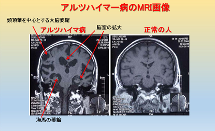 図8 アルツハイマー病のMRI画像