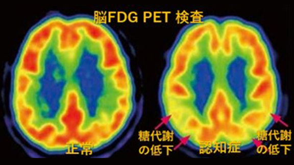 図9 脳FDG-PET検査
