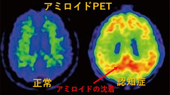 図10 アミロイドPET
