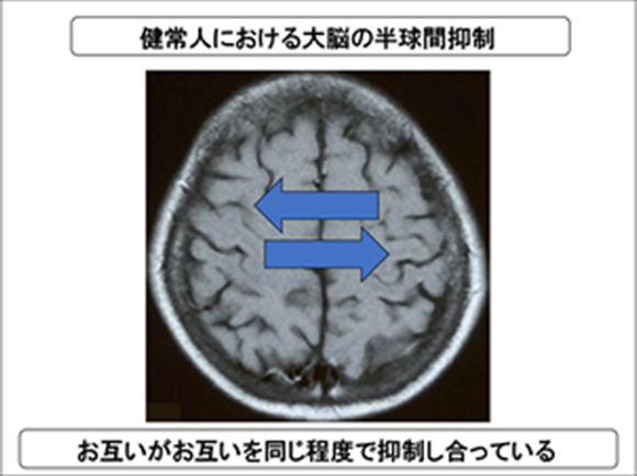 大脳における半球間抑制