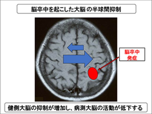 大脳における半球間抑制