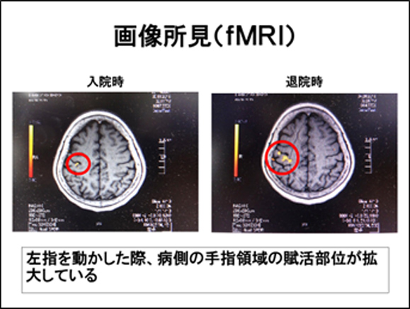 治療前後でのTMS治療の検証と退院後のフォロー